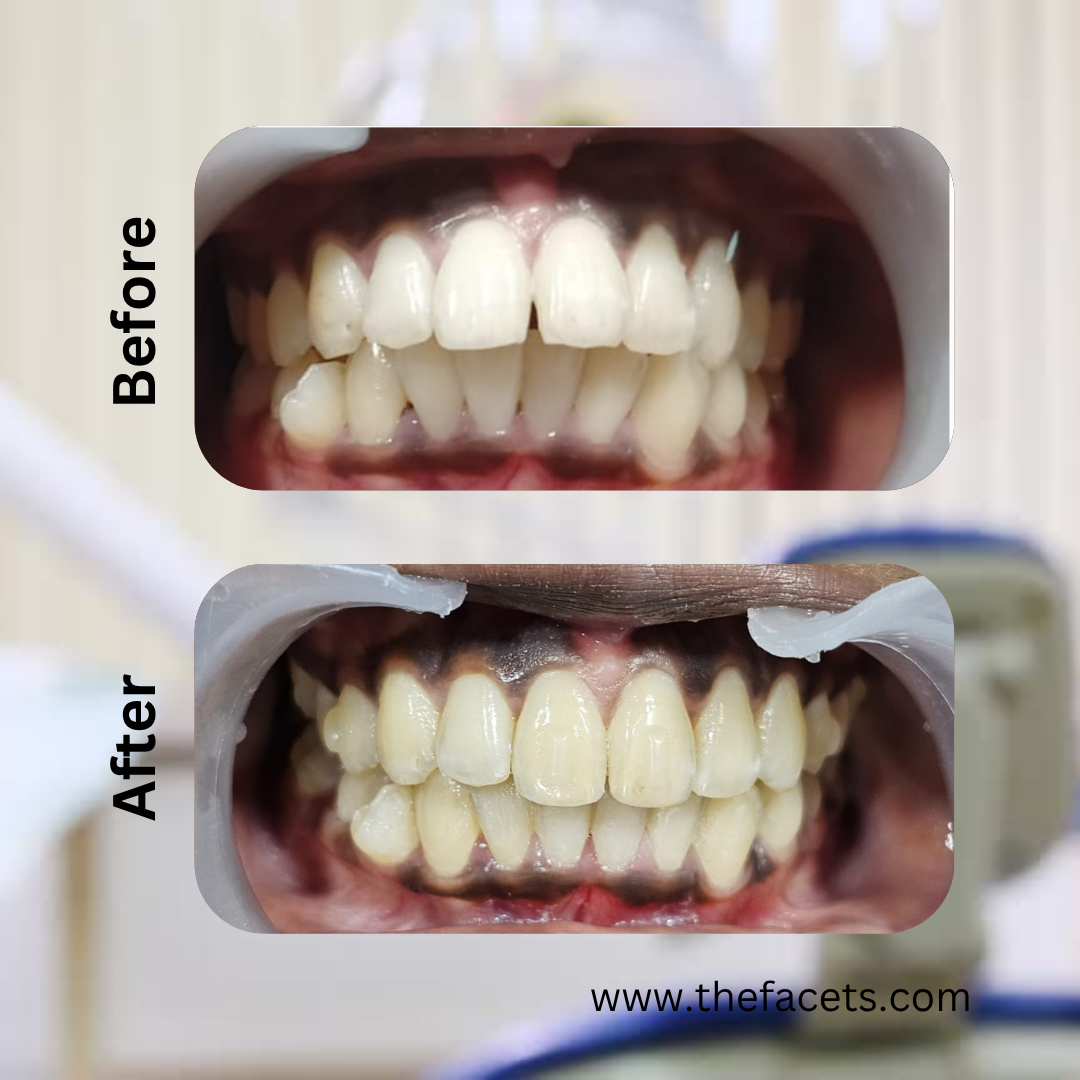 Before and after clear aligner treatment result 2